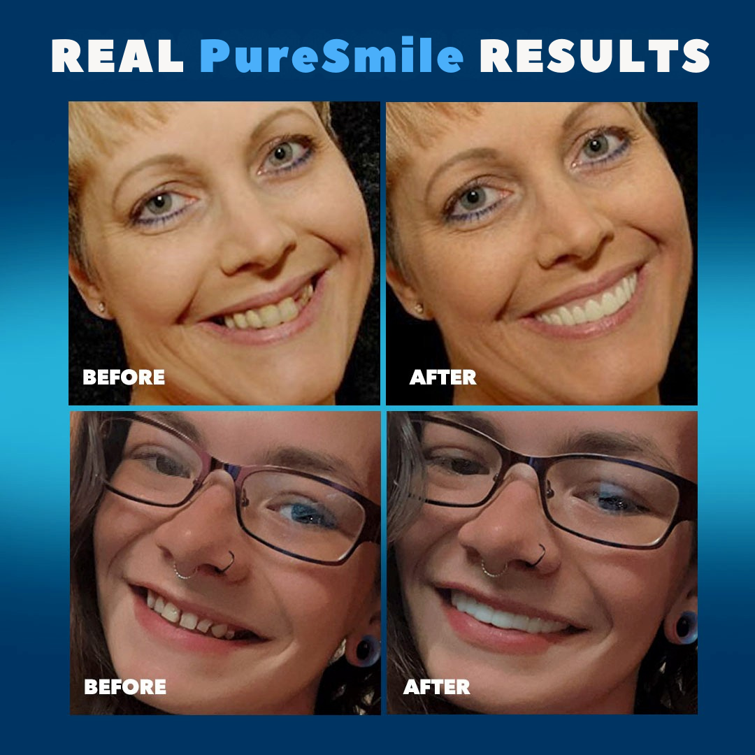 Purevlab Premium Cosmetic Teeth – DIY Smile Makeover